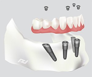 All-on-4 Dental Implants in Norwalk, CT